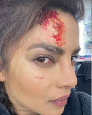 प्रियंका चोपड़ा फिल्म 'सिटाडेल' के सेट पर घायल हुईं,खून से लथपथ तस्वीर हुई वायरल