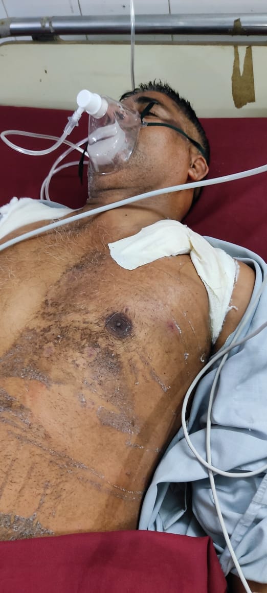 बरेली: आँवला के थाना सिरौली क्षेत्र के बड़ा गांव में पूर्व विधायक के बेटे को मारी गोली फैली दहशत।