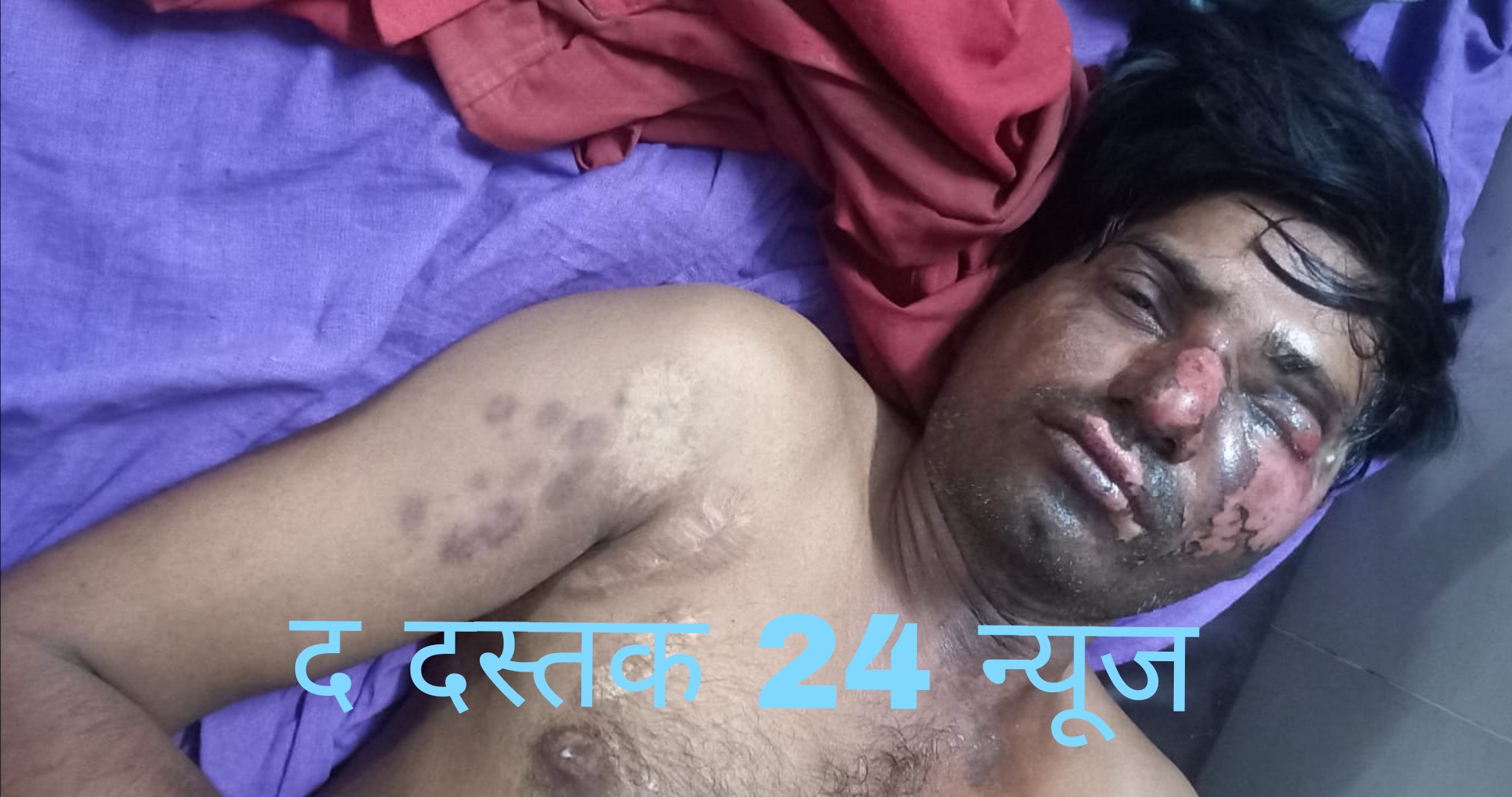 फर्रुखाबाद:दुर्घटनाग्रस्त लाइनमैन को बिजली विभाग कर कर रहा है अनदेखी