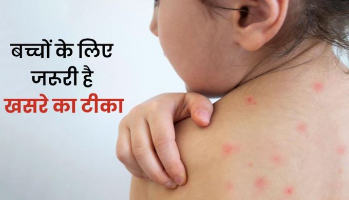 खसरे का खतरा भारत पर : आदर्श कुमार