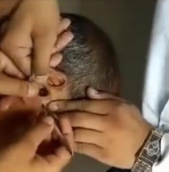 UPSSSC VDO के Re-Exam में एक नकलची का गजब का कारनामा, कान के अंदर डिवाइस छिपाकर कर रहा था नकल