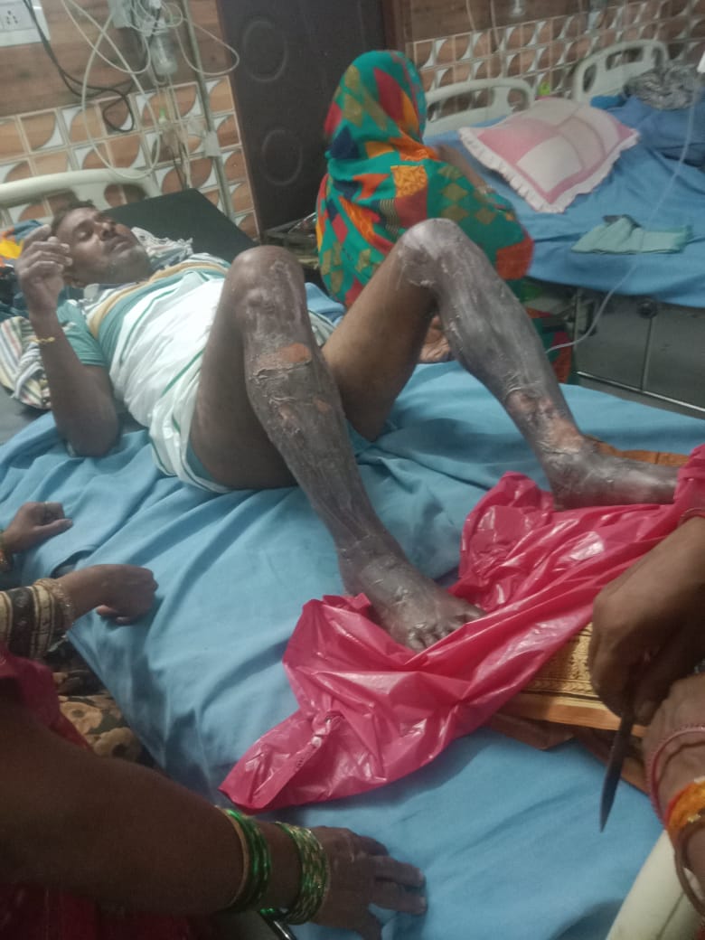 रायबरेली में शॉर्ट सर्किट की वजह से दुकान में लगी आग आग बुझाने के चक्कर में युवक हुवा गंभीर रूप से घायल