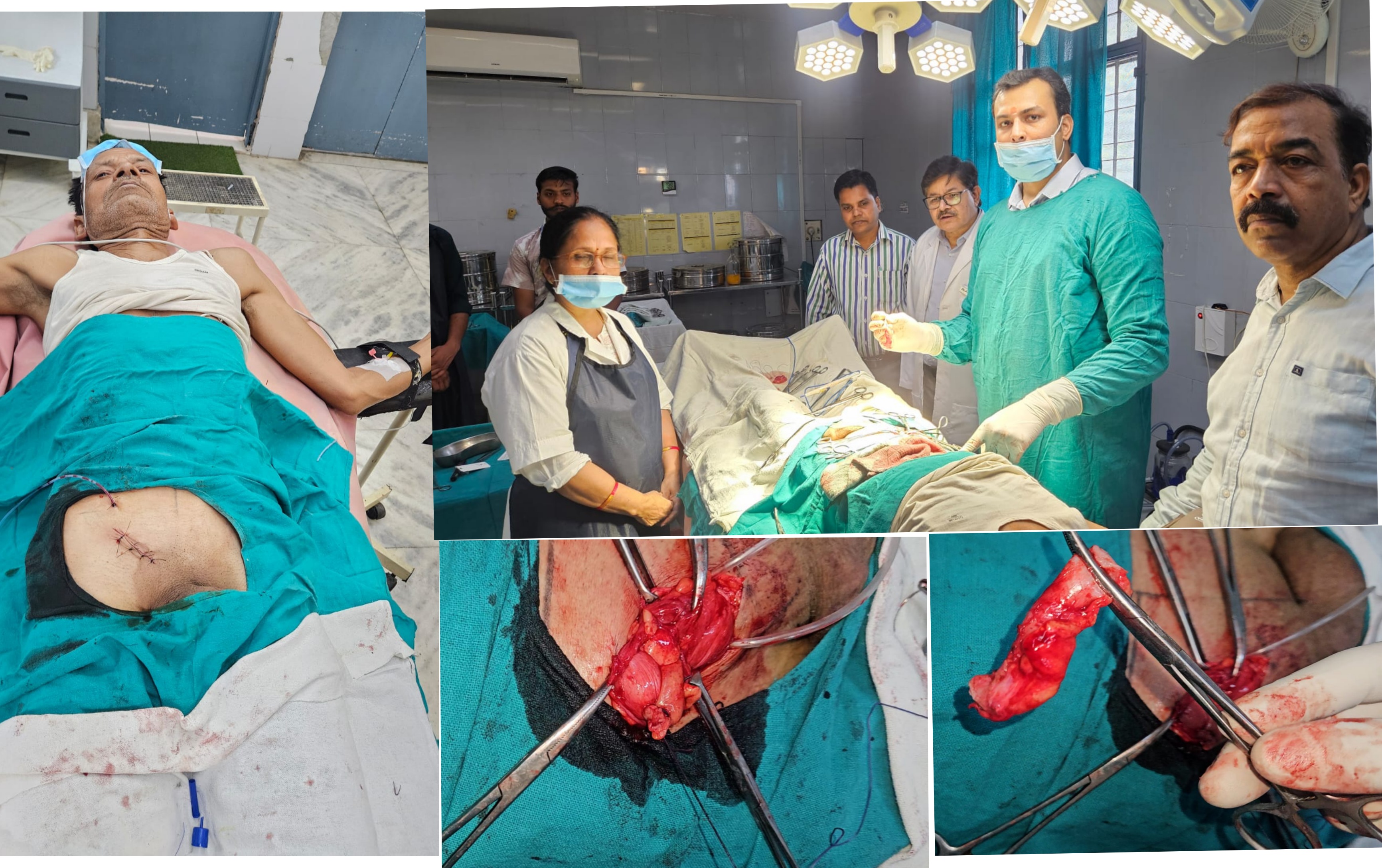 फर्रुखाबाद लोहिया अस्पताल में 1.5 करोड़ में एक होने वाली दुर्लभ Amyand's Hernia बीमारी की सफल निःशुल्क सर्जरी