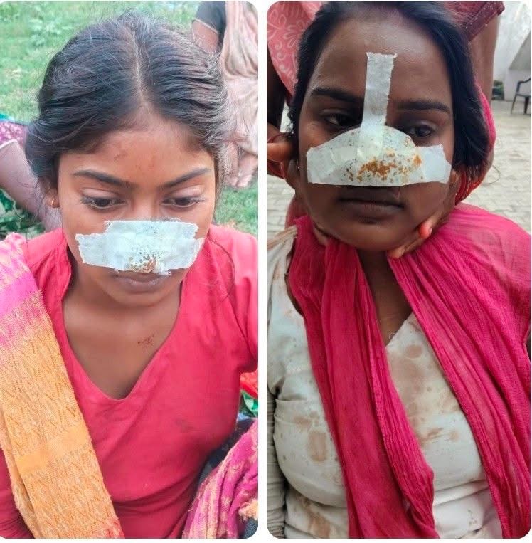 लखीमपुर: खीरी में लिया गया अनोखा बदला, नाक के बदले काटी नाक